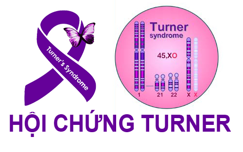 Hội chứng Turner (45,XO) ở nữ giới
